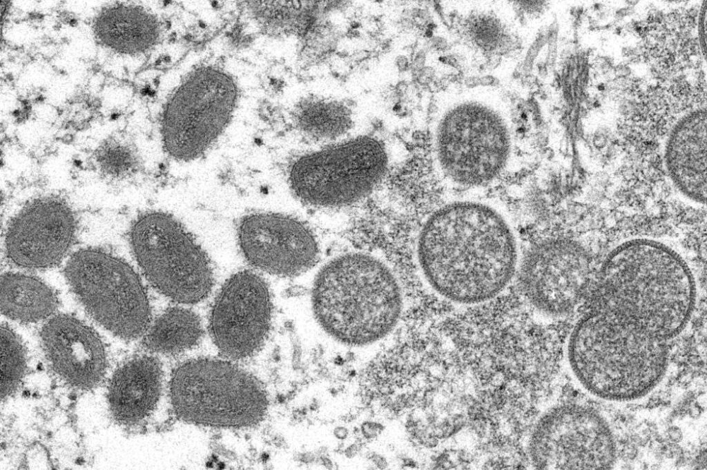 UP CLOSE AND PERSONAL This 2003 electron microscope image from the United States Centers for Disease Control and Prevention shows mature, oval-shaped monkeypox virions (left) and spherical, immature virions (right) obtained from a sample of human skin associated with a prairie dog outbreak in 2003. CDC PHOTO VIA AP