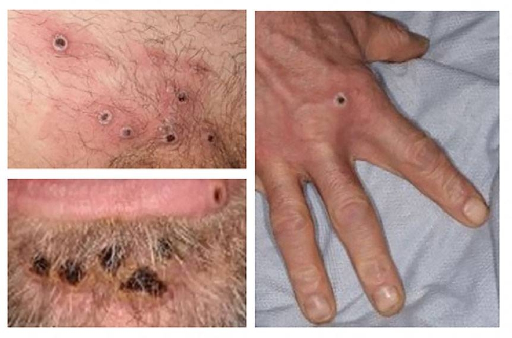 MYSTERIOUS SPREAD This file handout photo taken on Wednesday, June 22, 2022, made available by the UK Health Security Agency shows a collage of monkeypox rash lesions at an undisclosed date and location. AFP PHOTO/ UK HEALTH SECURITY AGENCY