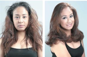 Before and after with the Soft Wave Treatment