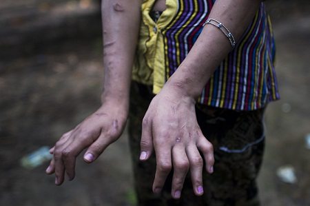 San Kay Khine stares at her burnt, scarred hands, her twisted fingers a reminder of her years as a child slave in Myanmar, one of thousands of young domestic workers feared to be at risk of exploitation and abuse. The pair are among tens of thousands of children from poor rural areas sent to work as domestic helpers for the country's growing pool of wealthier, urban middle-class households. AFP PHOTO